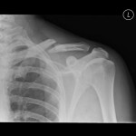 X-ray of Broken Shoulder Bone